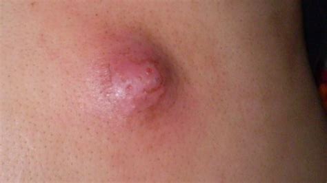 Infected Sweat Gland In Armpit Groin Causes Pictures Treatment Home