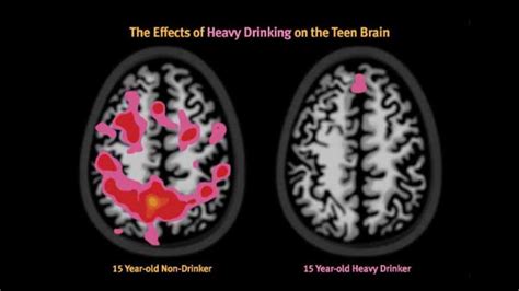 Safe Driving Effects Of Alcohol And Drug Abuse On Teens