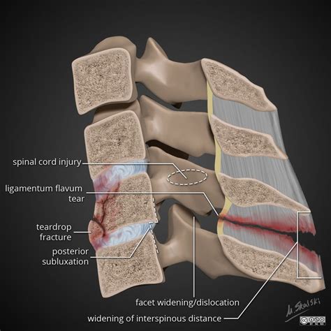 Flexion Teardrop Fracture Illustration Radiology Case Radiopaedia