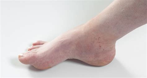 Type 2 Diabetes Leg Swelling Sciencehub