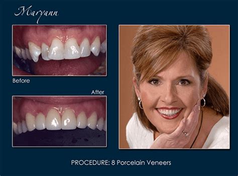 Porcelain Veneers Dental Associates Orland Park