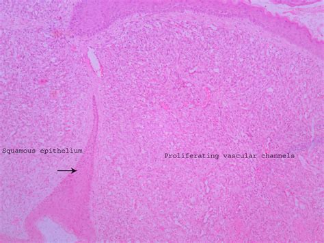 Capillary Hemangioma Histopathologyguru