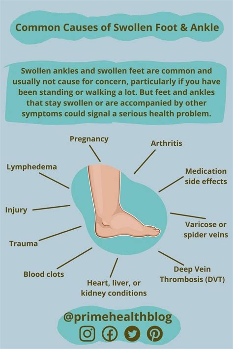 Swollen Ankles And Feet Causes Of Foot Ankle Swelling Artofit