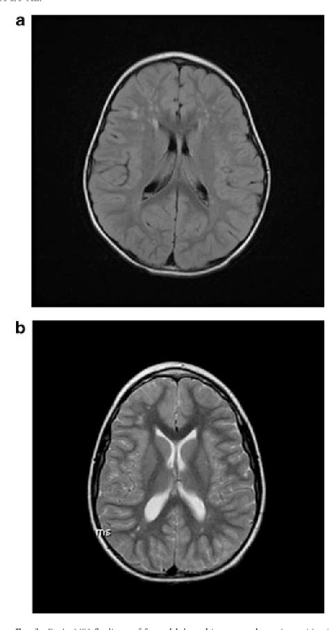 Figure 3 From A New Look At Xxyy Syndrome Medical And Psychological