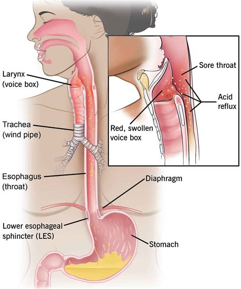 Esophageal Stricture Causes Symptoms Diagnosis Treatment Prognosis