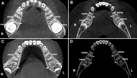 Representative Cbct Images Of Three Rooted Mandibular Molars