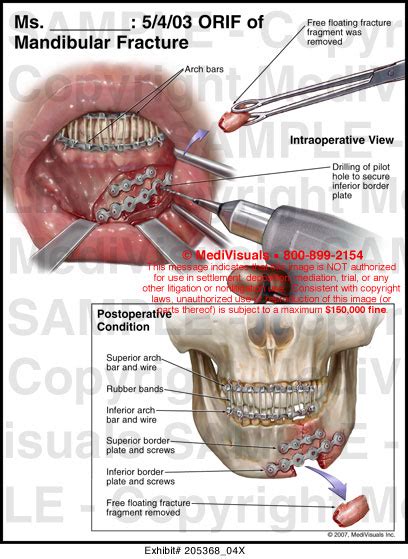 5403 Orif Of Mandibular Fracture Medical Illustration