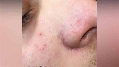 Pimple Popping Blackheads Pustules And Acne Treatment Youtube