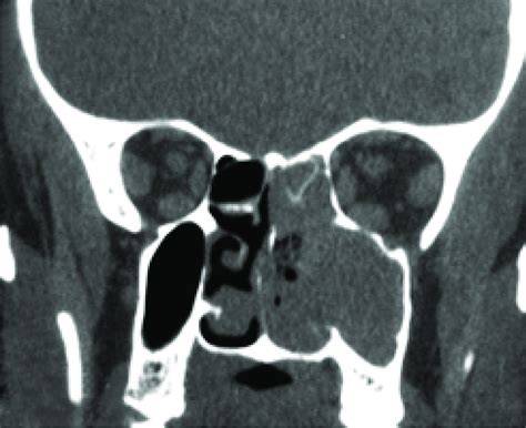 Plain Computed Tomography Of Paranasal Sinuses Ct Pns Coronal View