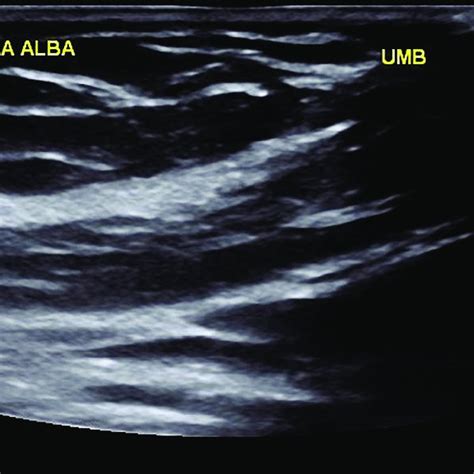 Lumbar Hernia Ultrasound