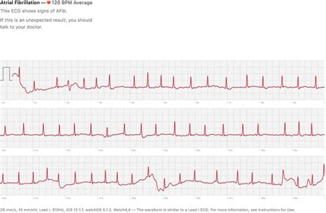 Apple Ecg App Detects Afib In Watch Series 4 Owner Saves Life All You