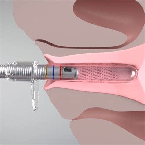 Achieving Vaginal Rejuvenation With Laser Vaginal Therapy Inner Beauty