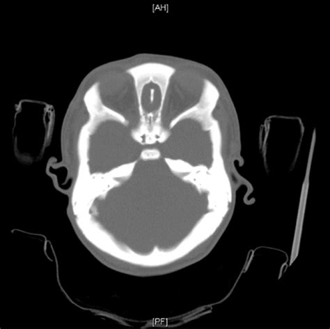 Ct Head 3 D Reconstruction Showing Oxycephaly With Bone Growth Around