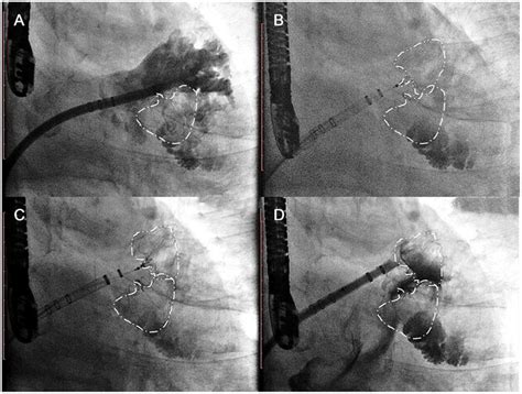 Single Sheath Strategy Step 5 A Selective Angiography Of The Second