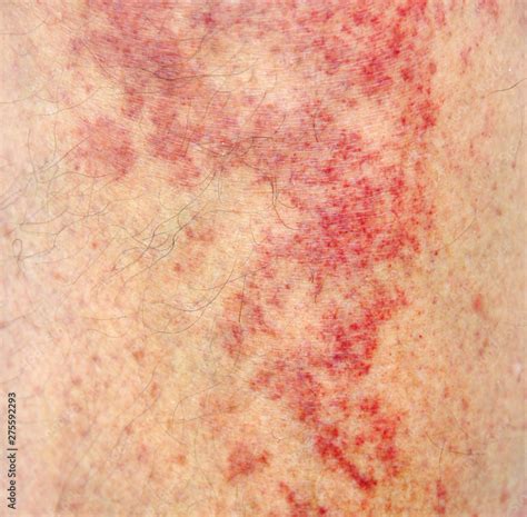 Allergic Contact Dermatitis At Shin Stock Photo Adobe Stock