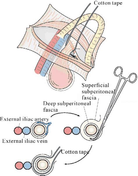 Figure From Femoral Hernia A Review Of The Clinical Anatomy And