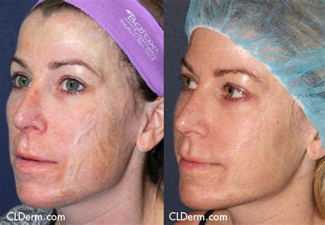 Laser Treatment For Burns San Diego Ca Cosmetic Laser Dermatology