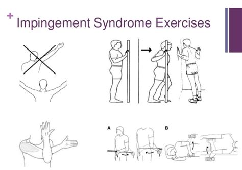 Shoulder Impingement Syndrome Symptomscausesdiagnosis And Treatment