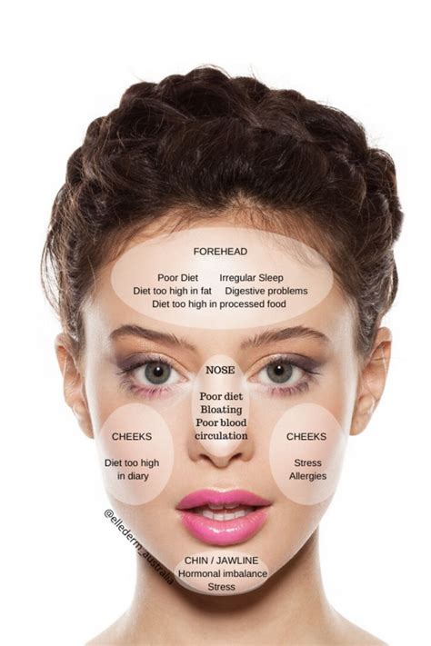 Acne Face Mapping Face Mapping Acne Face Acne Acne Diet