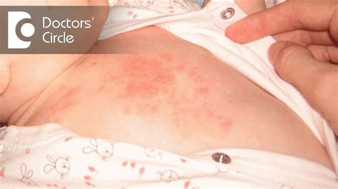 Itchy Rash On Stomach Belly Button Rash Causes Symptoms Medicaverse A Rash Is A