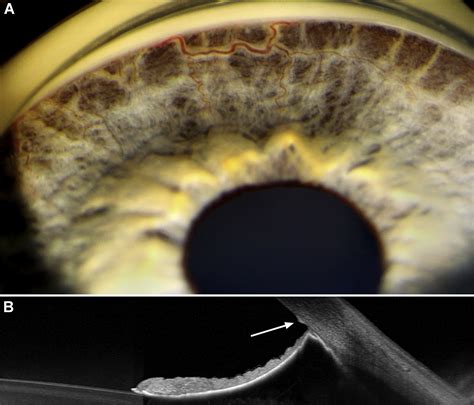 High Iris Insertion In Axenfeld Rieger Syndrome Ophthalmology