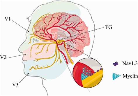 Trigeminal Neuralgia Wikimsk