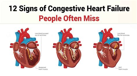 12 Signs Of Congestive Heart Failure People Often Miss Stages Of Heart