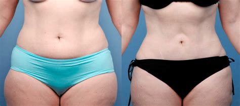 Flank Liposuction Everything You Need To Know International Clinics