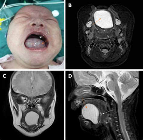 Sublingual Dermoid Cyst