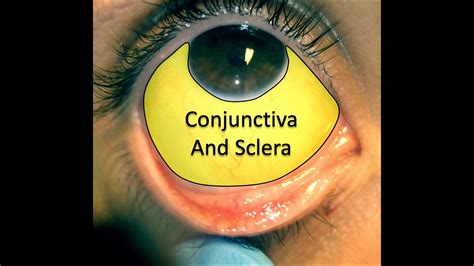 Conjunctiva And Sclera