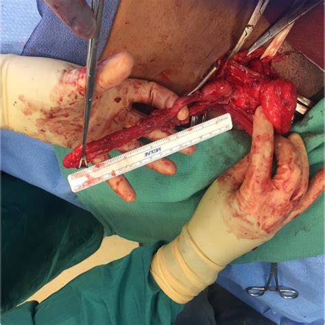 Ct Showing An Incarcerated Right Inguinal Hernia With Small Bowel In