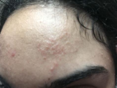 Forehead Rash Or Acne General Acne Discussion Community