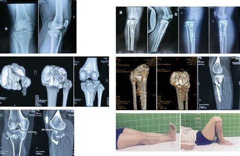Surgical Treatment Of Lateral Tibial Plateau Fractures Involving The