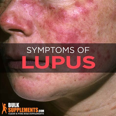 Drug Induced Lupus