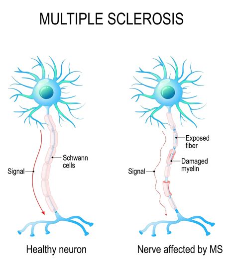 Multiple Sclerosis|Wellness Guru Australia