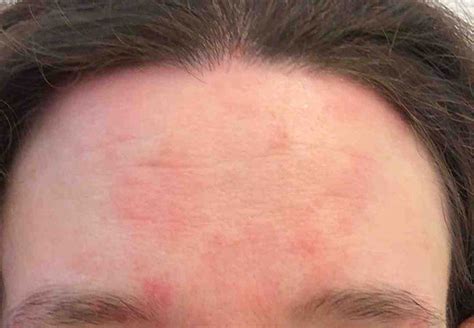 Alcohol Seizures Treatment Eczema On Forehead Treatment
