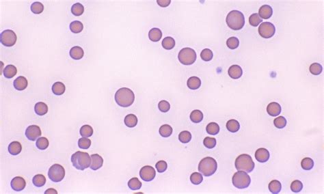 Anisocytosis Cells And Smears