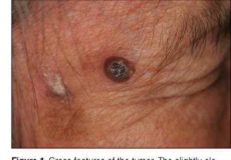 Figure 1 From Microinvasive Squamous Cell Carcinoma Arising Within
