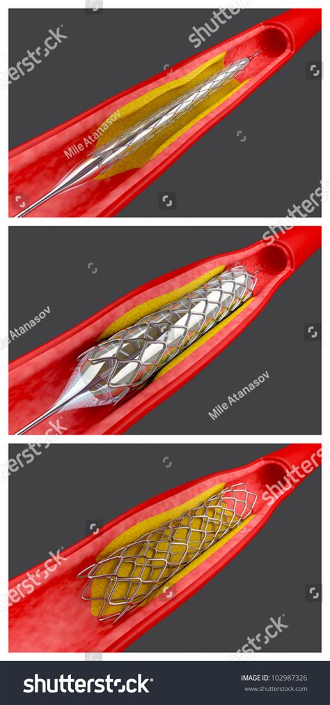 Balloon Angioplasty Procedure With Placing A Stent Stock Photo