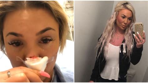 Toronto Woman Got Her Nose Bitten Off By Her Boyfriend On New Years Eve