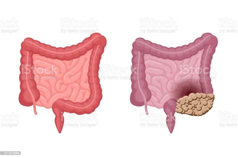 Human Intestines Anatomy Strong Healthy And Unhealthy With Colon Cancer