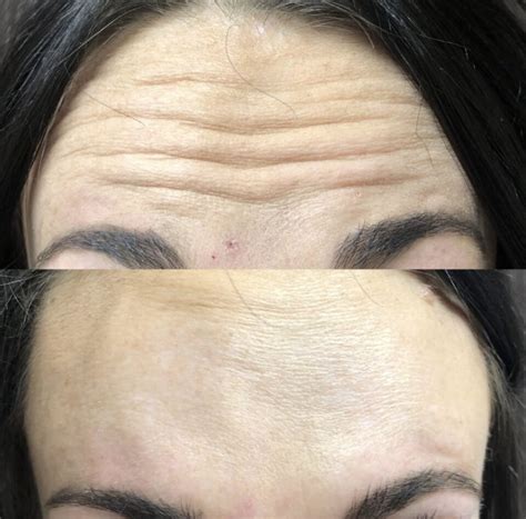 We Can Reduce Forehead Wrinkles In Northglenn Co