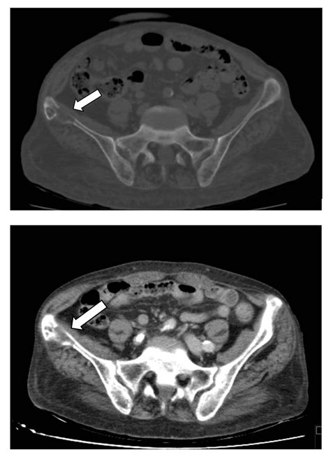 Cureus Secondary Hyperparathyroidism Presenting As A Brown Tumor A
