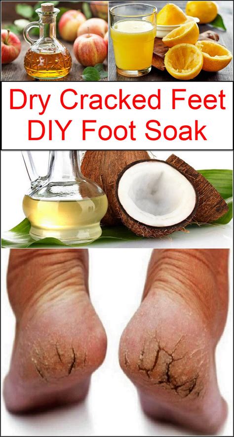 Vinegar For Feet Dry Scalp Listerine Foot Soak