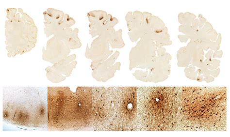 Cte Brain Vs Normal Pet Scan Of The Brain For Depression Mayo Clinic