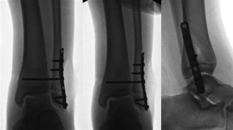Case 1 Anteroposterior Mortise And Lateral Radiographic Views Of The