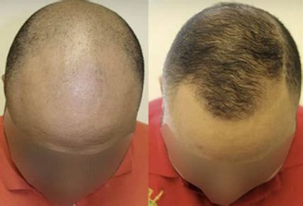 Before And After FUE Procedure 3000 Grafts Toronto Hair Transplant