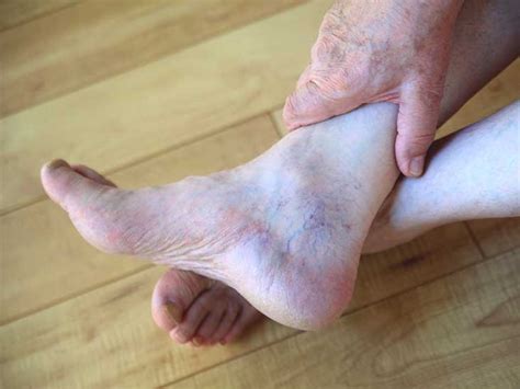 Psoriatic Arthritis Hands Feet And More