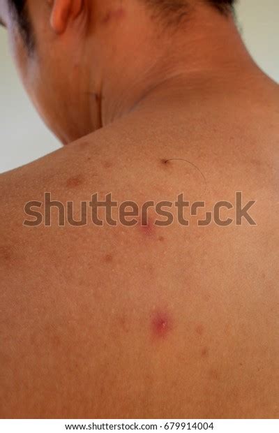 Man Acne Red Spots On Back Stock Photo Edit Now 679914004