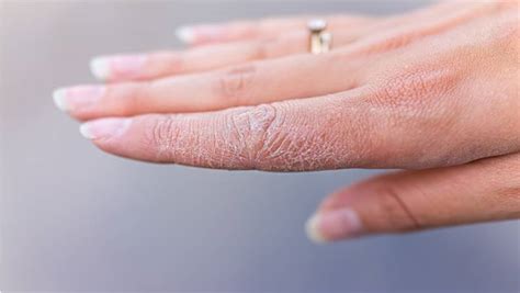 How To Treat Dry And Cracked Hands Skin Cancer Specialists
